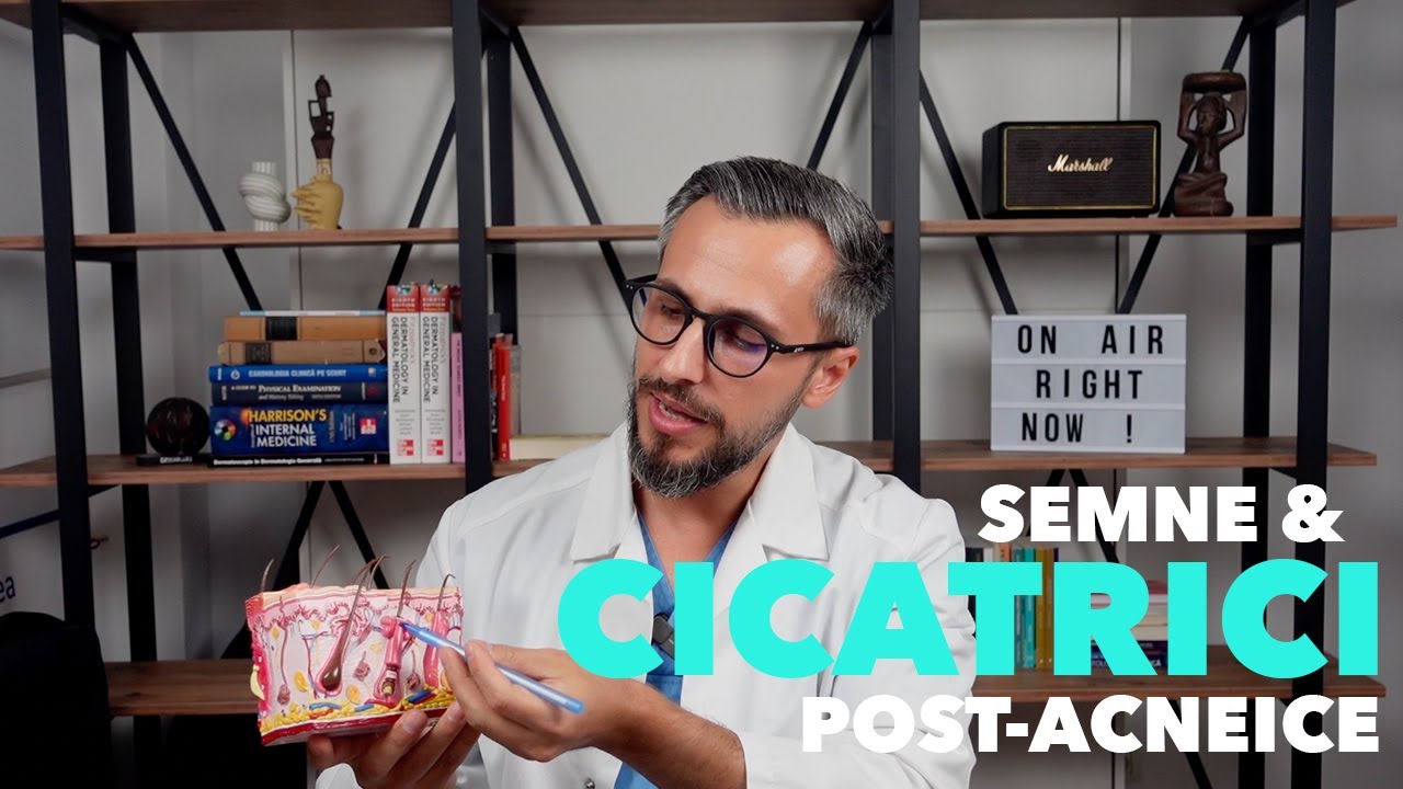 CUM SA REDUCI ASPECTUL CICATRICILOR SI SEMNELOR POST ACNEICE
