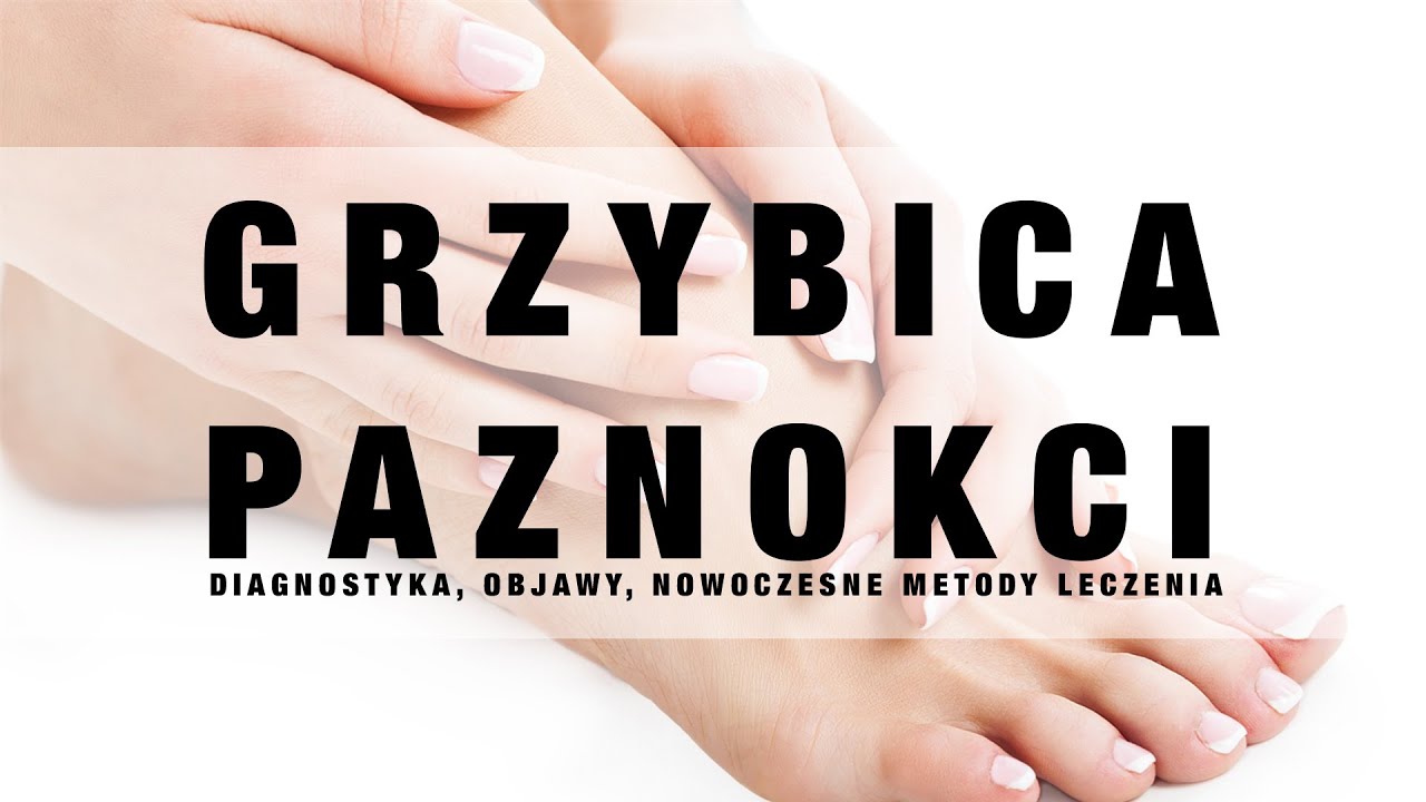 MIRALEX e-TV ODC. 3 GRZYBICA PAZNOKCI – DIAGNOSTYKA, OBJAWY, NOWOCZESNE METODY LECZENIA