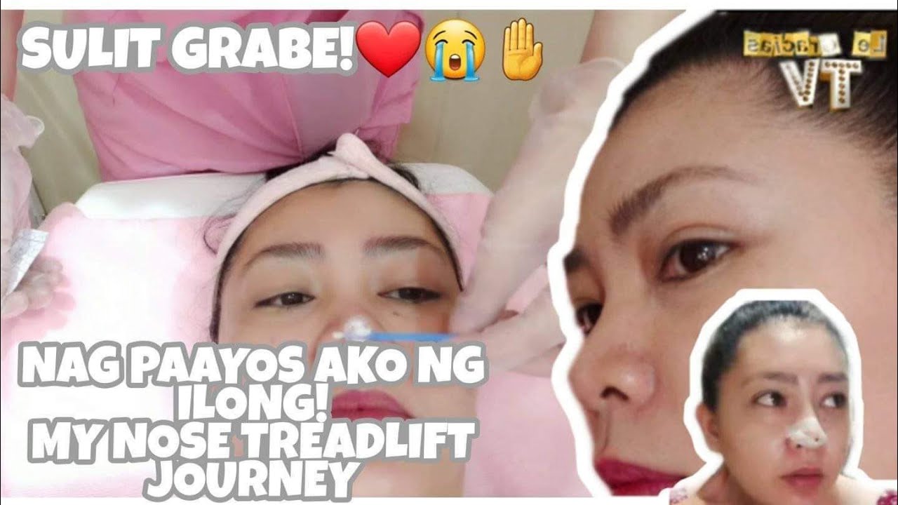 I GOT A NOSE JOB | Hiko Nose Thread lift Experience and Recovery vlog @pinkwork