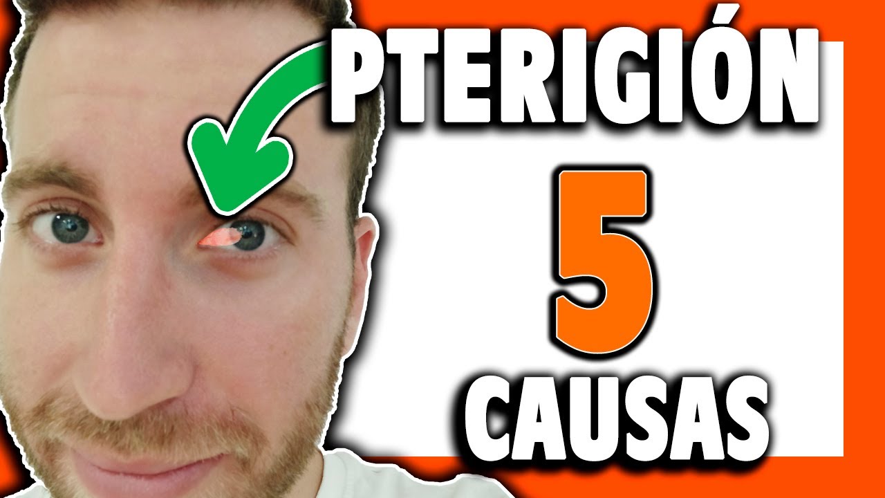 ⚠️ &iquest;Por qu&eacute; SALE el PTERIGION o CARNOSIDAD? [Cap&iacute;tulo #2]