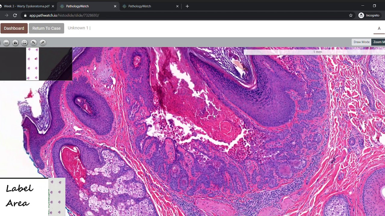Warty Dyskeratoma