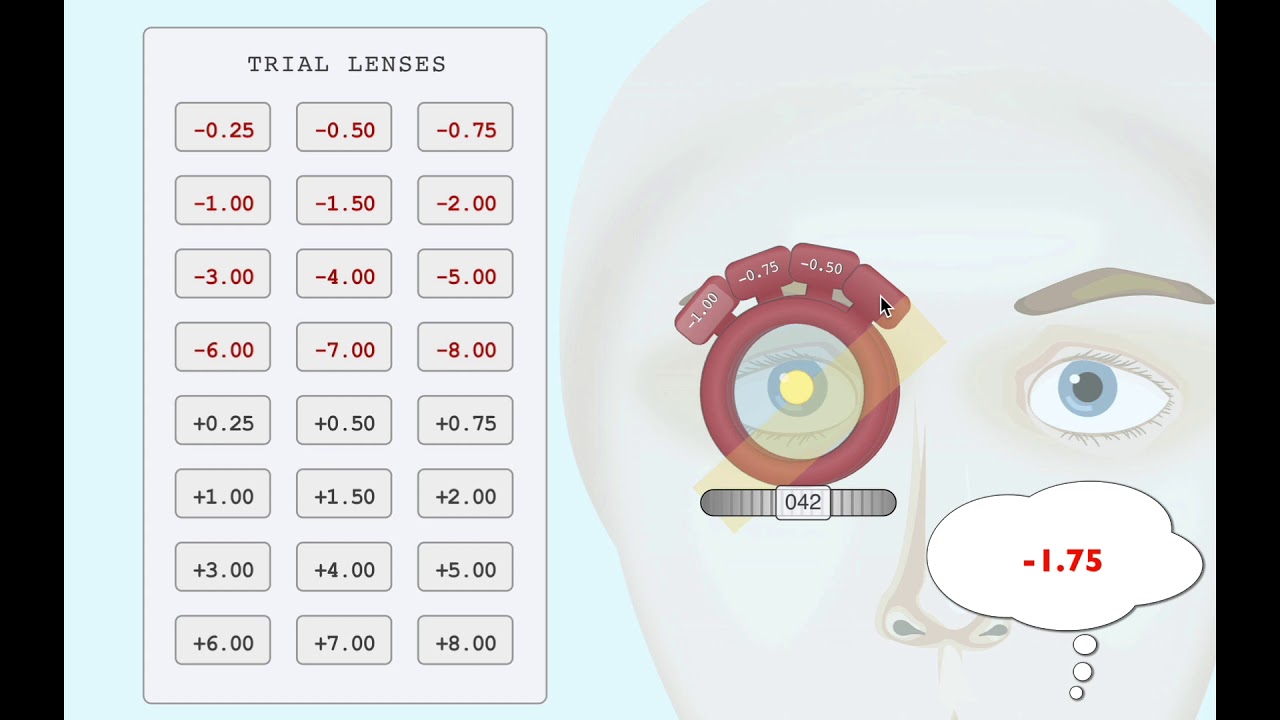 Retinoscopy with trial lenses (Minus cylinder)