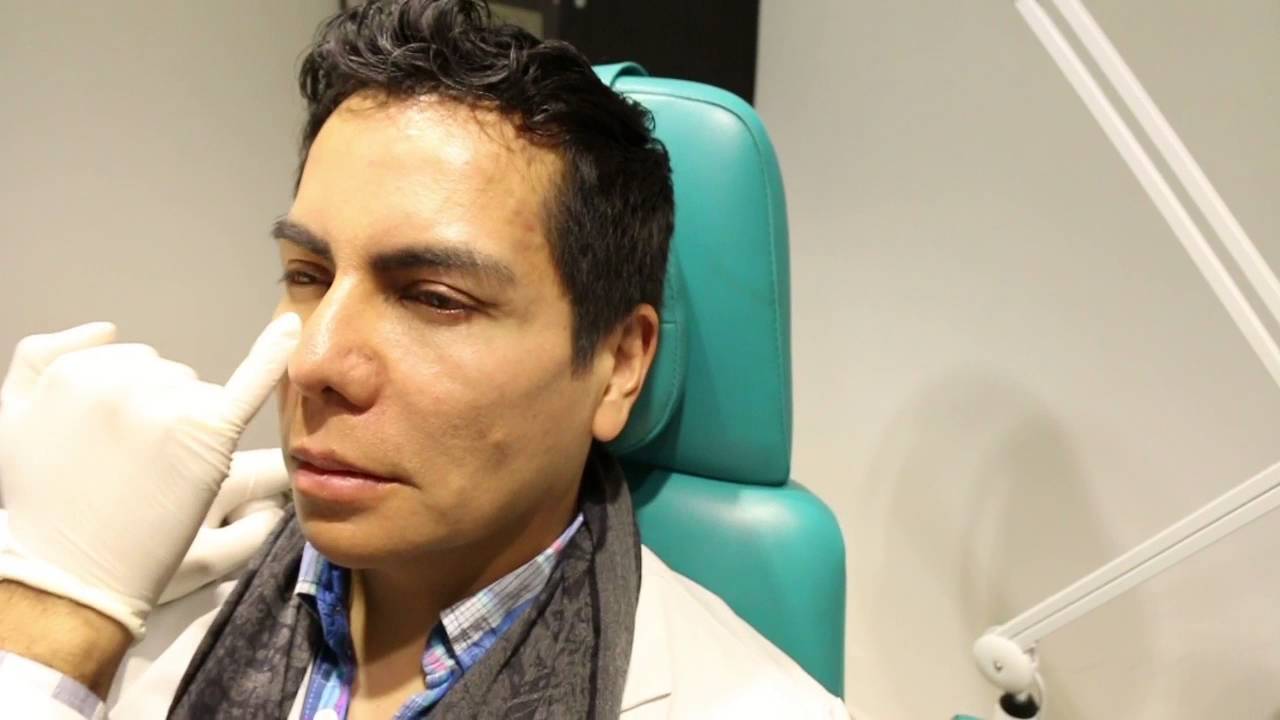 Quitar ojeras Rapido/ Relleno de Ácido Hialurónico