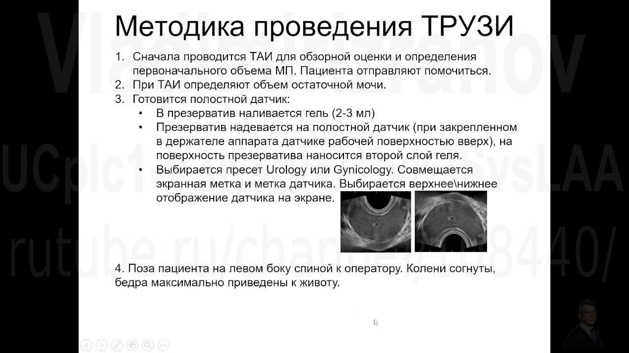 УЗИ предстательной железы. Методика. Запись 2022 12 27 14 08 39