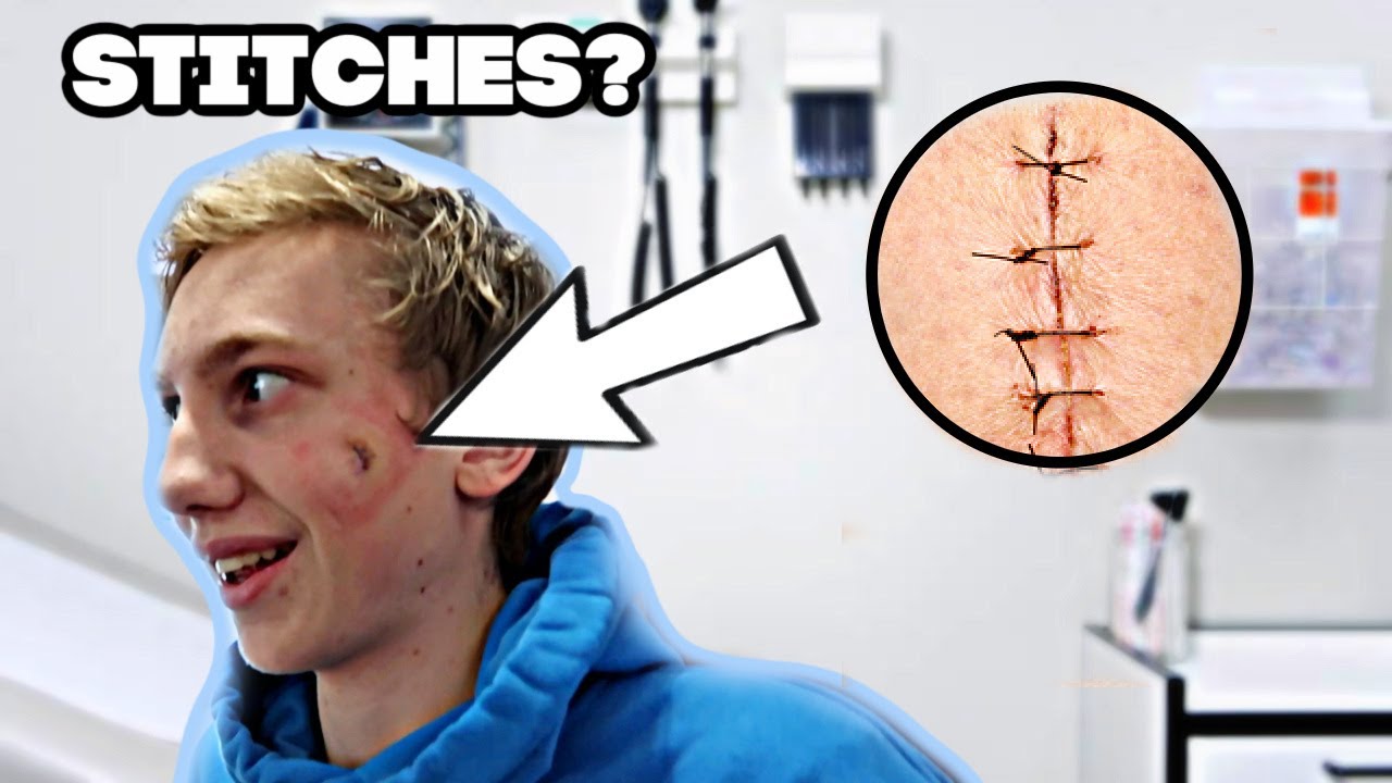 Matthew got STITCHES!
