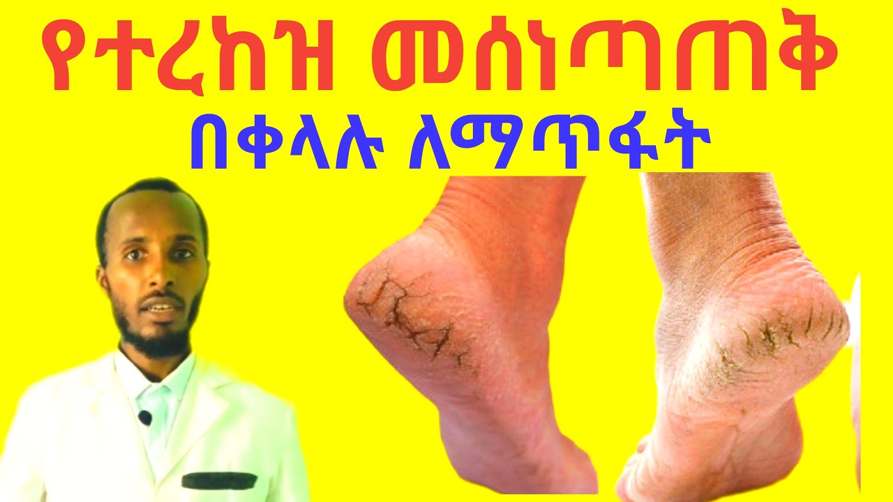 የእግር መሰነጣጠቅ መንስኤዎችና ፍቱን ተፈጥሮአዊ መፍትሄዎች Cracked heels causes and home remedy