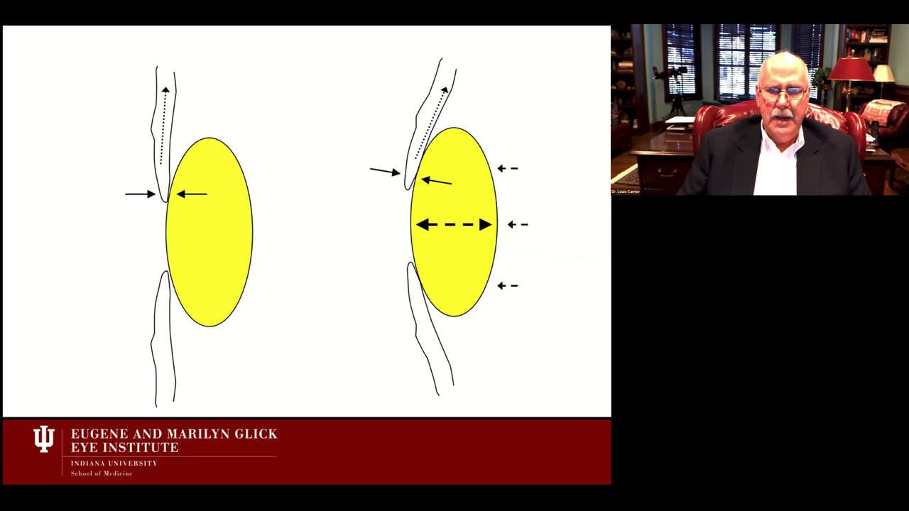 Lecture: Angle Closure Glaucoma: Primary and Secondary