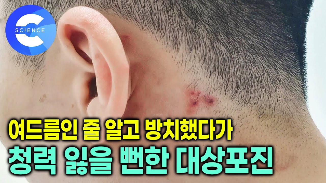 치료시기 놓치면 평생 신경통으로 고생할 수 있다고? 🚨 대상포진 골든타임 단 3일! 대상포진 예방주사 효과있을까? | 신경을 파괴하는 대상포진 | 명의