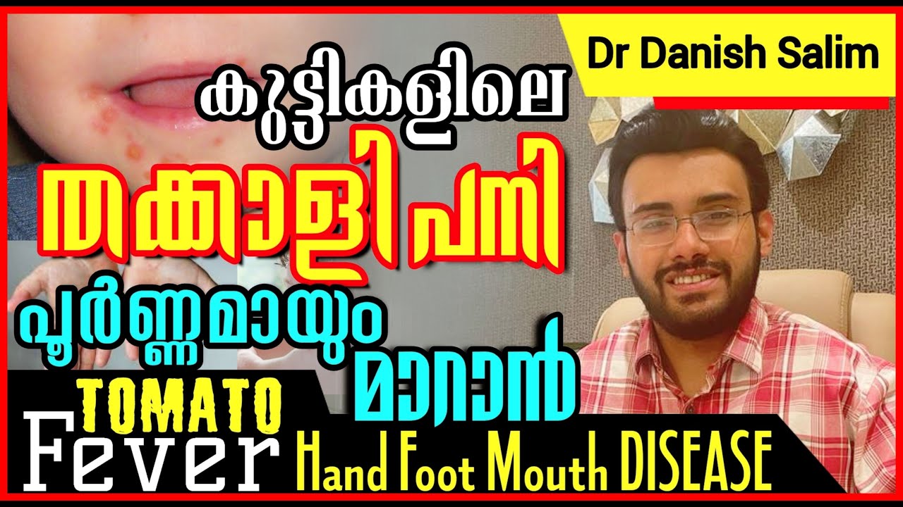 1033: 👶 കുട്ടികളിലെ തക്കാളി പനി ലക്ഷണങ്ങളും പരിഹാര മാർഗ്ഗങ്ങളും | Tomato fever danger symptoms
