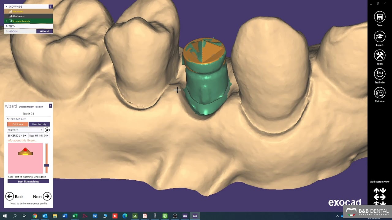 B&B Dental | CEREC base on Exocad