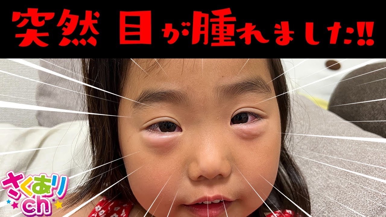 【病院】目が腫れてしまいました…急いで眼科へ行ってきました💦大丈夫かな？