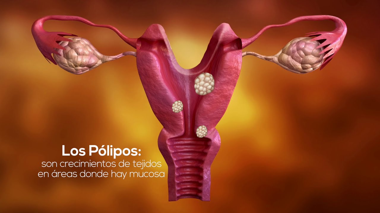Pólipos Endometriales