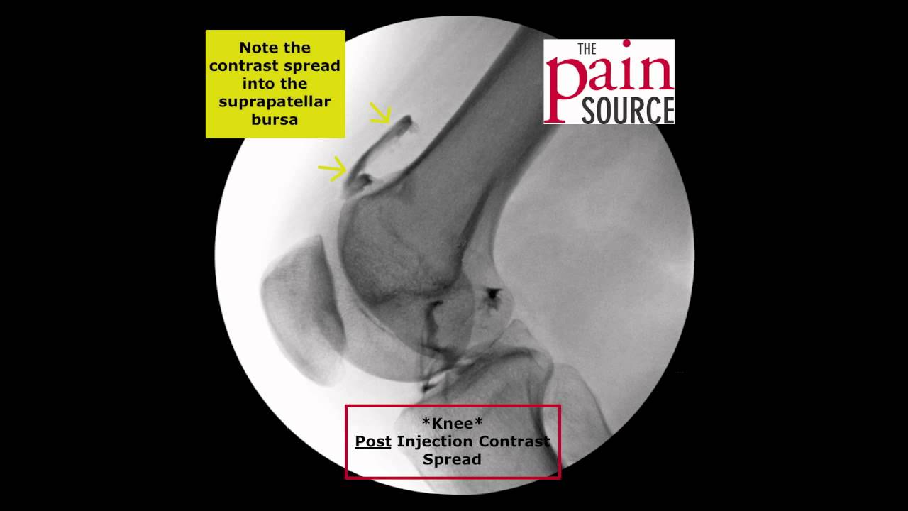 Knee Injection under Fluoroscopy  - ThePainSource.com