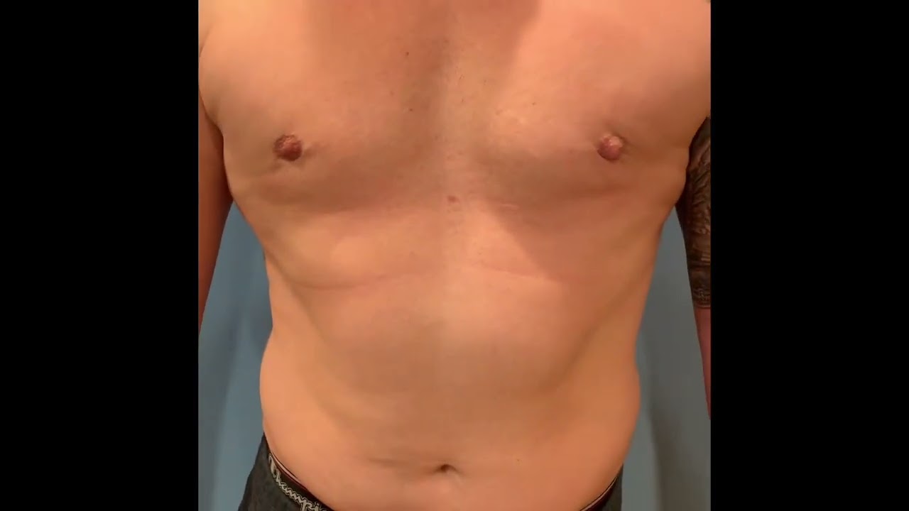 Fixing BOTCHED Gynecomastia NEW YORK Male: Vaser HI-DEF LIPO, 6-Pack ABS & PECTORAL LIPOFILLING 💪🏼
