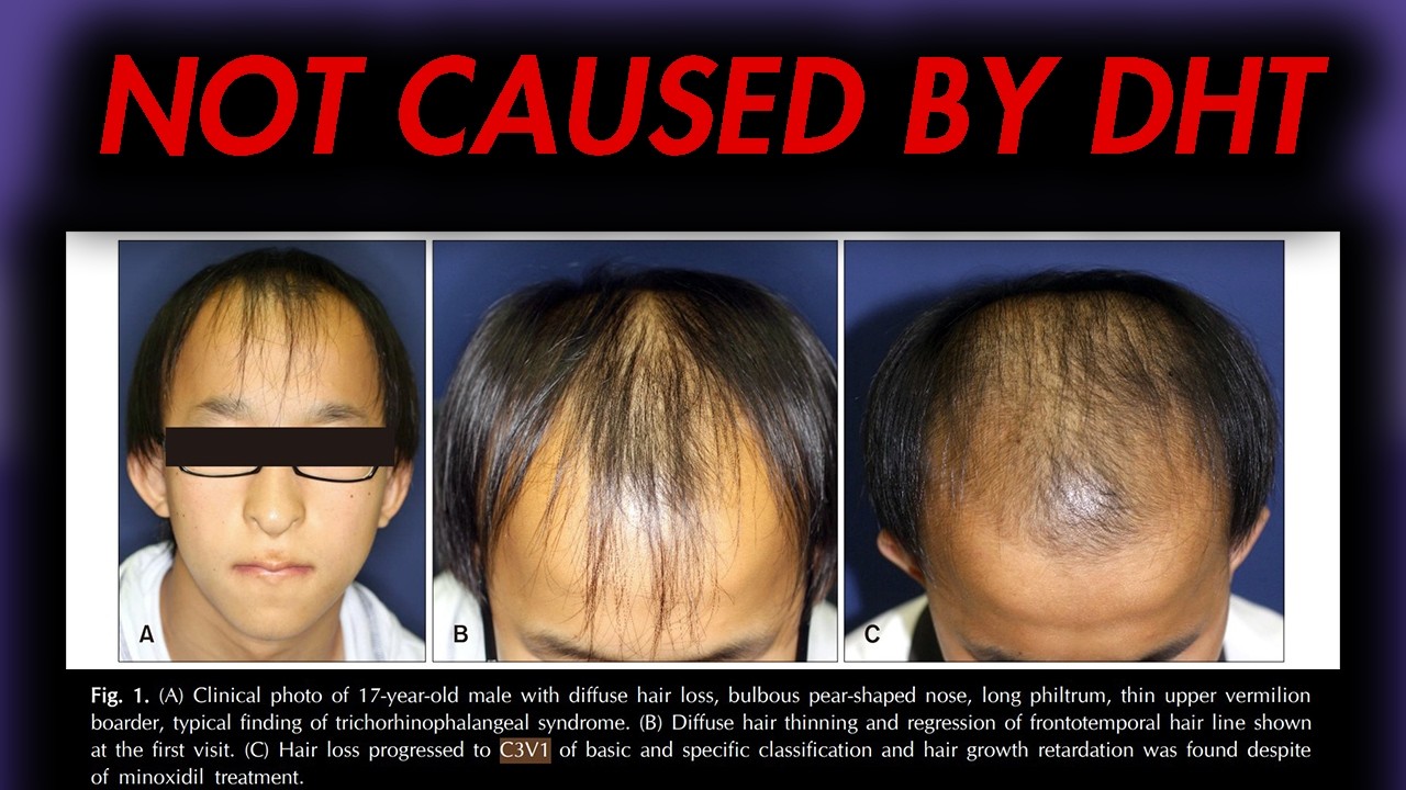 Why Hair Loss Hasn't Been Cured Yet: Meschenymal Stem Cells