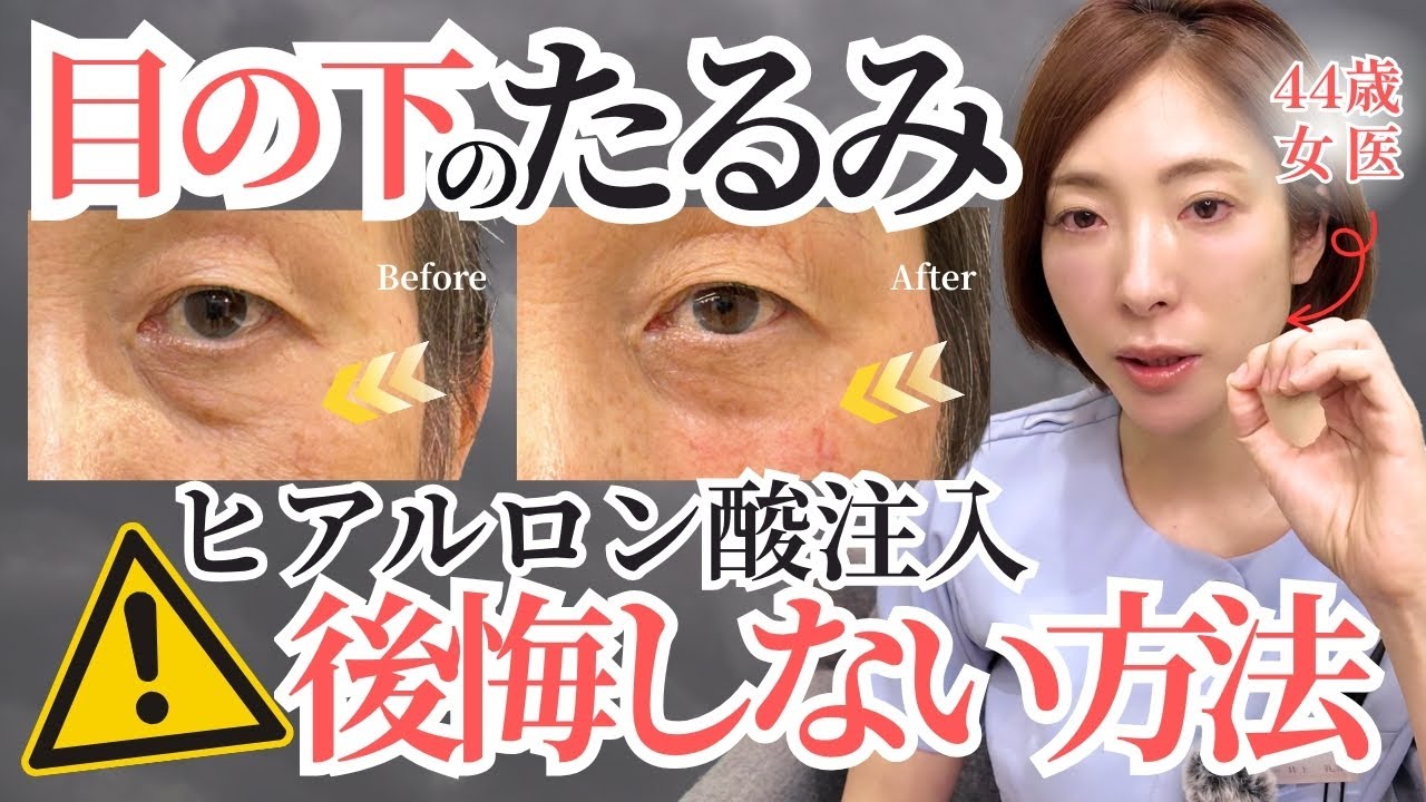【目の下のクマ】ヒアルロン酸注入で切らずに若返り！皆さんの疑問を44歳美容皮膚科医が徹底解説します！