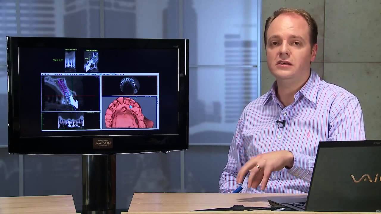 Implante Unit&aacute;rio Imediato com carga imediata