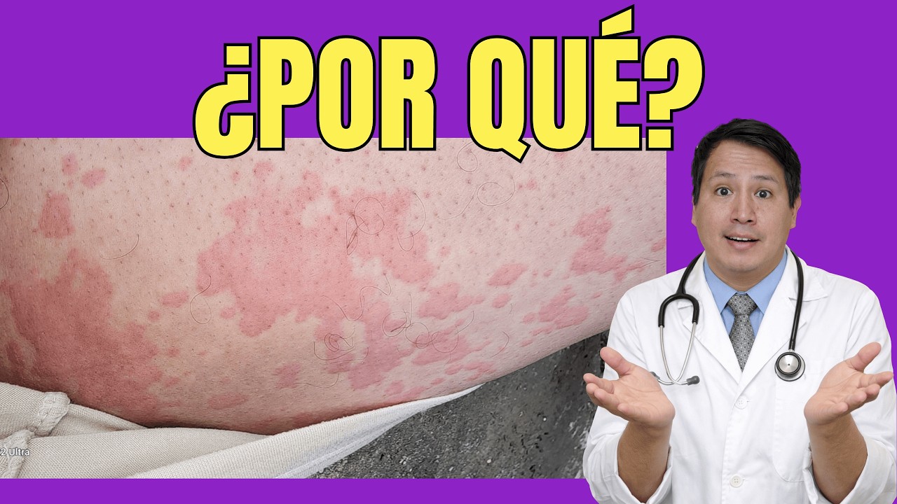 Urticaria crónica: las causas ocultas que nadie te explica