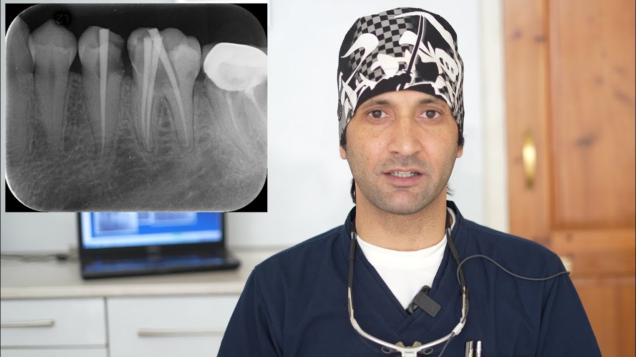 Root Canal Treatment of the Mandibular Second Premolar and First Molar Tooth In a Single Sitting.