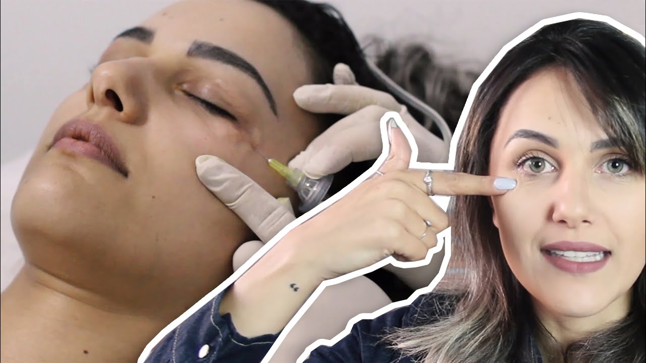 Carboxiterapia para olheiras