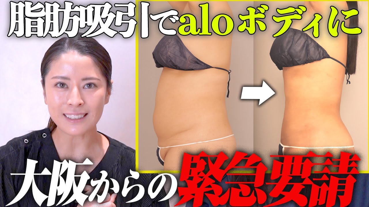 【緊急来院】大阪から井口先生の脂肪吸引を受けに来ました✨