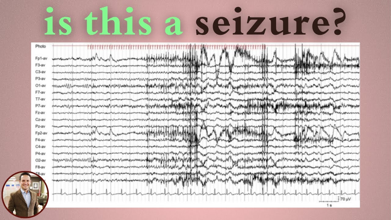 Photomyoclonic Response on EEG: Not a Seizure! Here’s Why