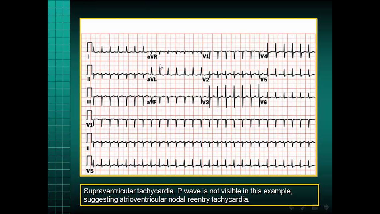 Narrow Complex Tachycardia