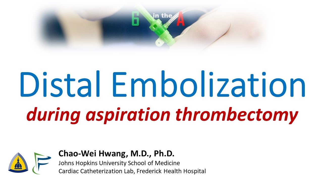 Distal embolization during aspiration thrombectomy