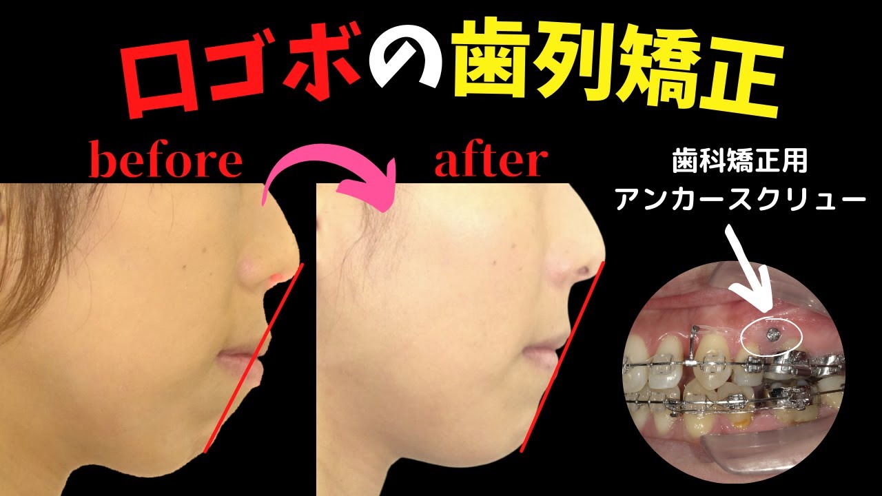 口ゴボ改善の歯列矯正を解説│アンカースクリュー│Eライン│開咬の表側矯正