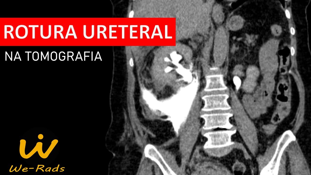 Rotura Ureteral na Tomografia Computadorizada (TC)