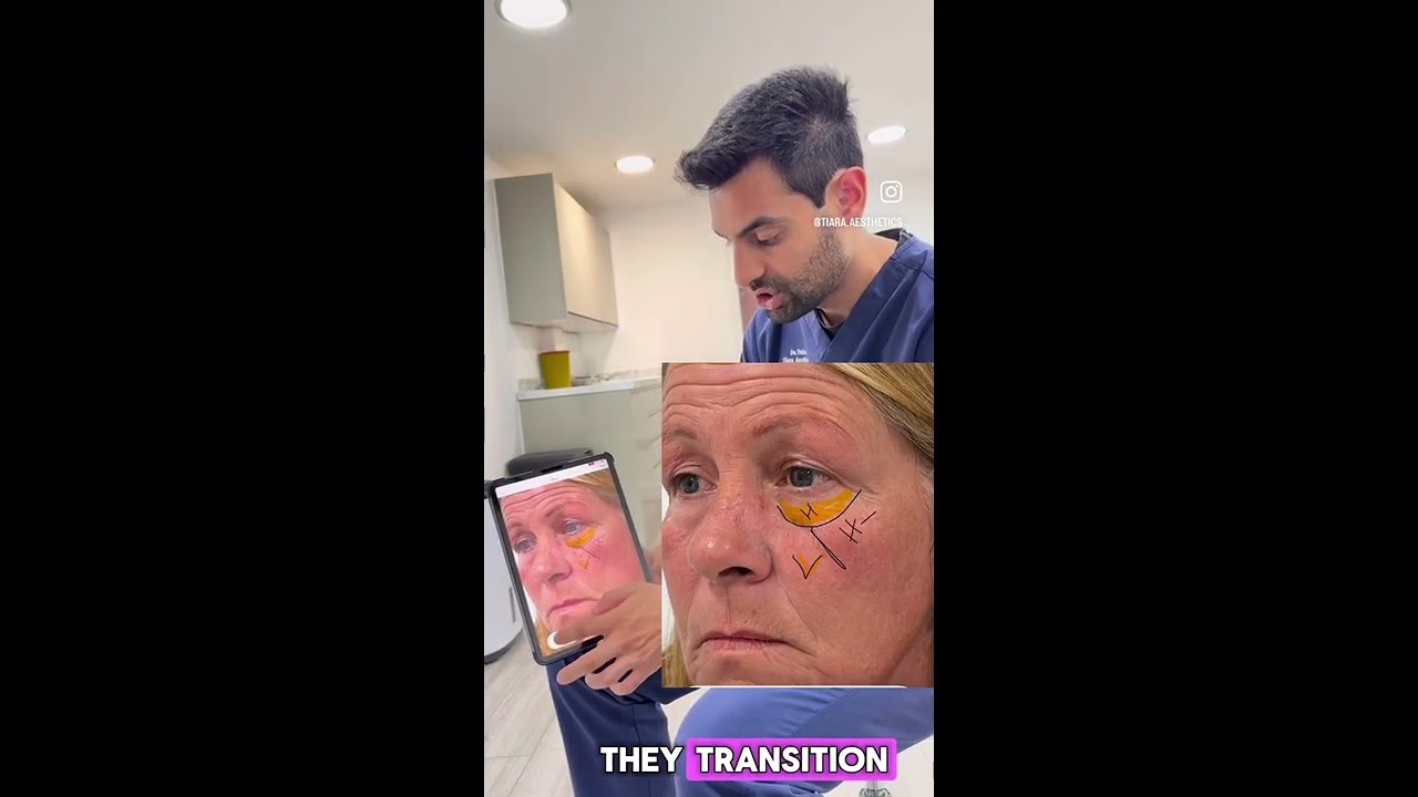 Dr Thiara discusses the filler placement in the mid-face area.