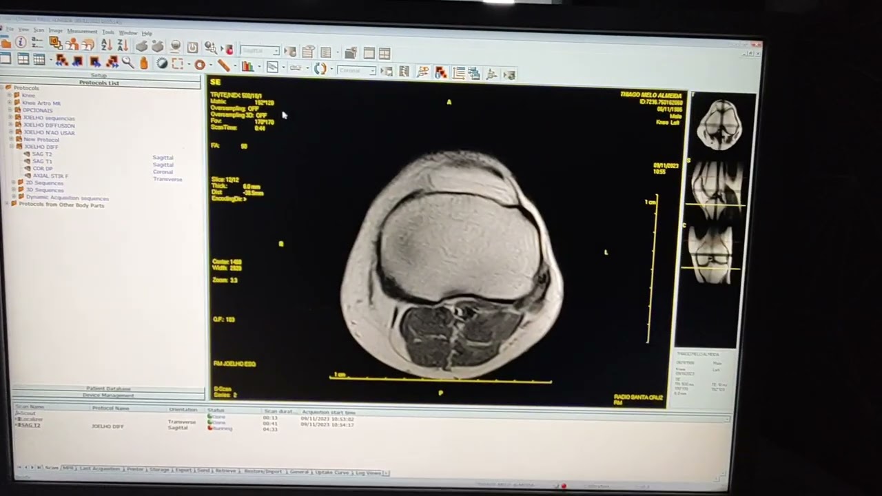 Aquisição de RM Joelho na RM Esaote S-Scan