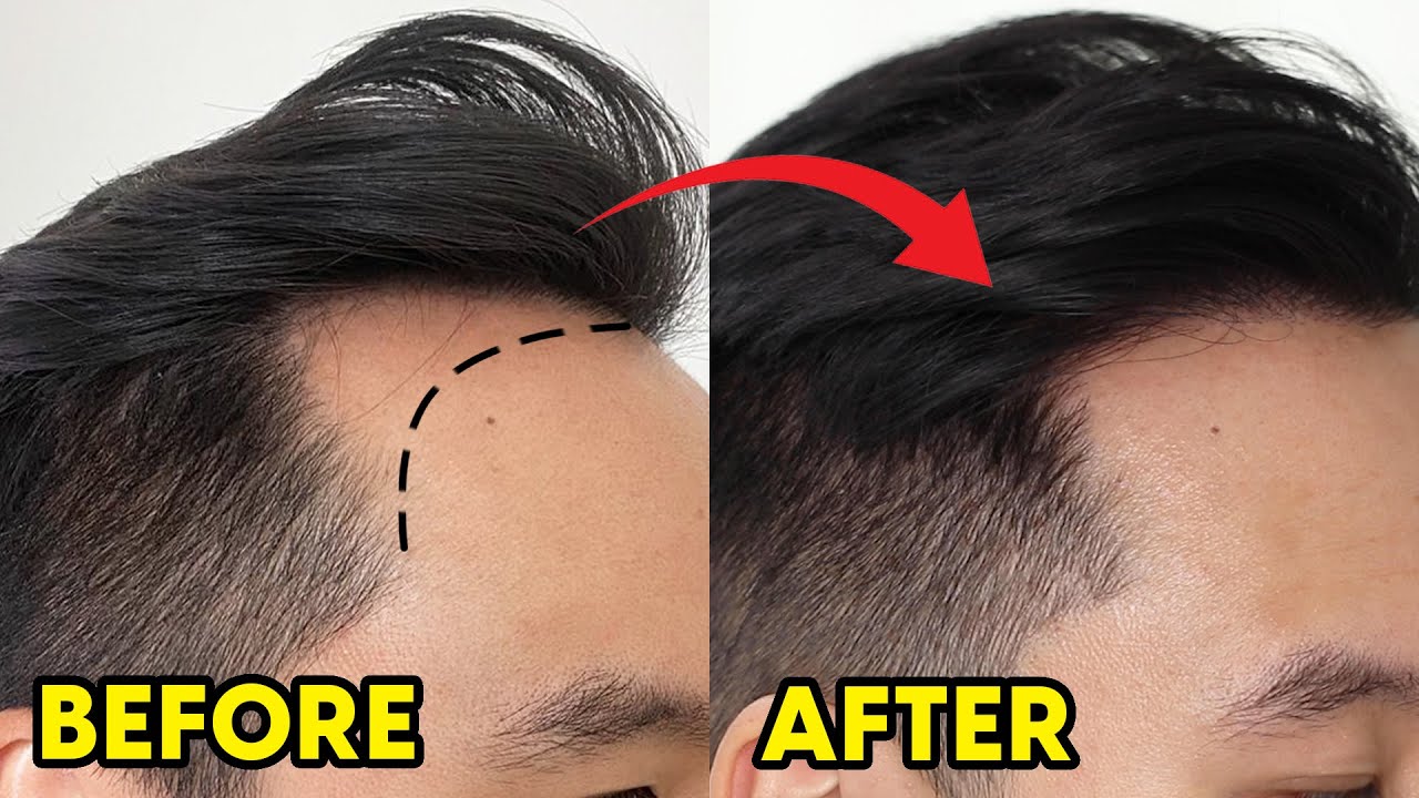Hair Transplant Before & After - 1 Year Results