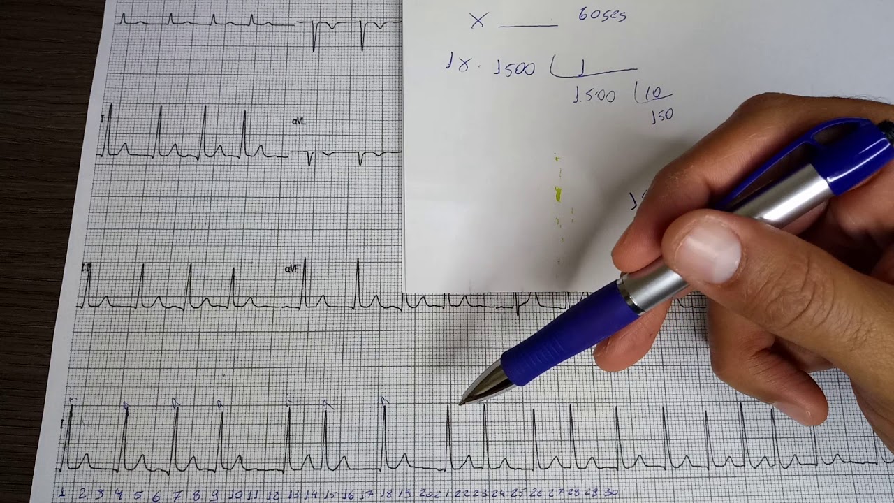 Calculo da frequência cardíaca ritmo irregular