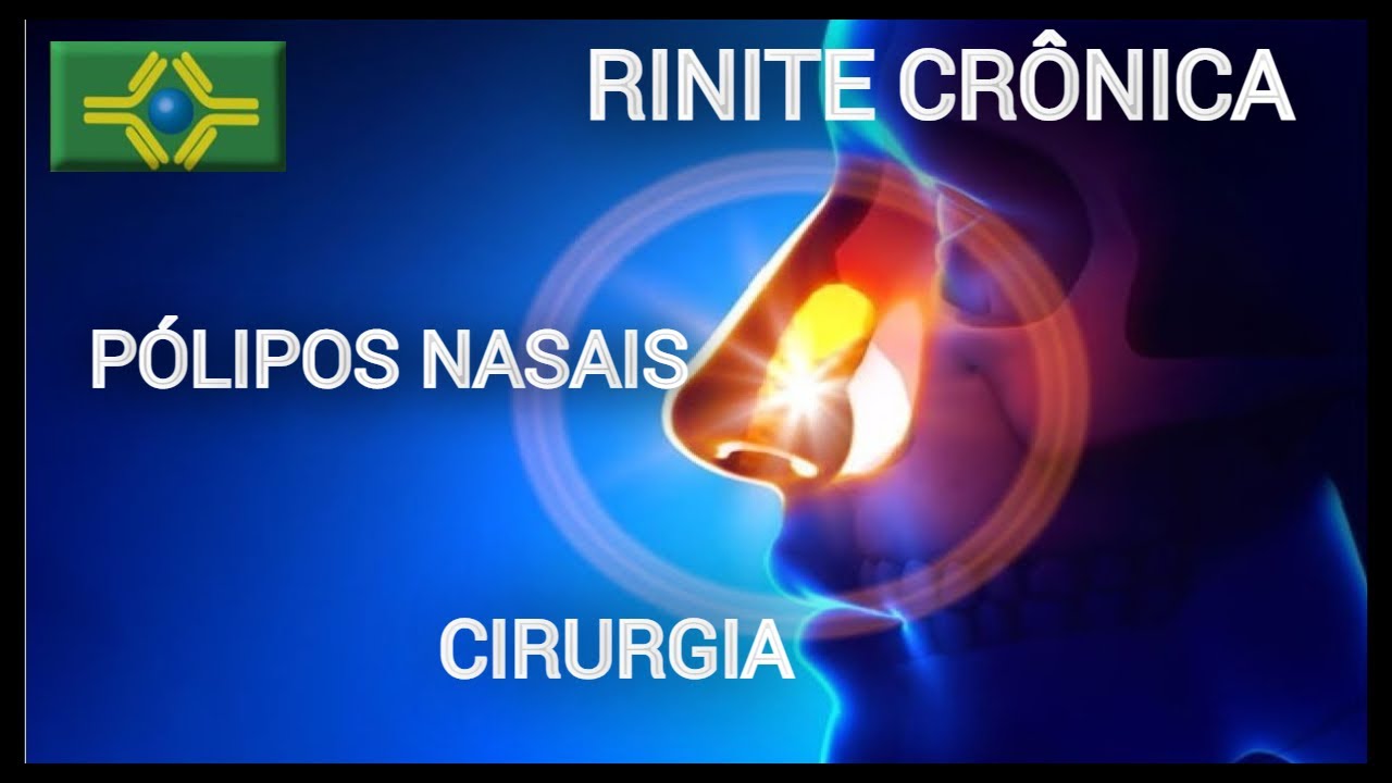 RINITE CRÔNICA | PÓLIPOS NASAIS | Benefícios da CIRURGIA? DR MARCELLO BOSSOIS