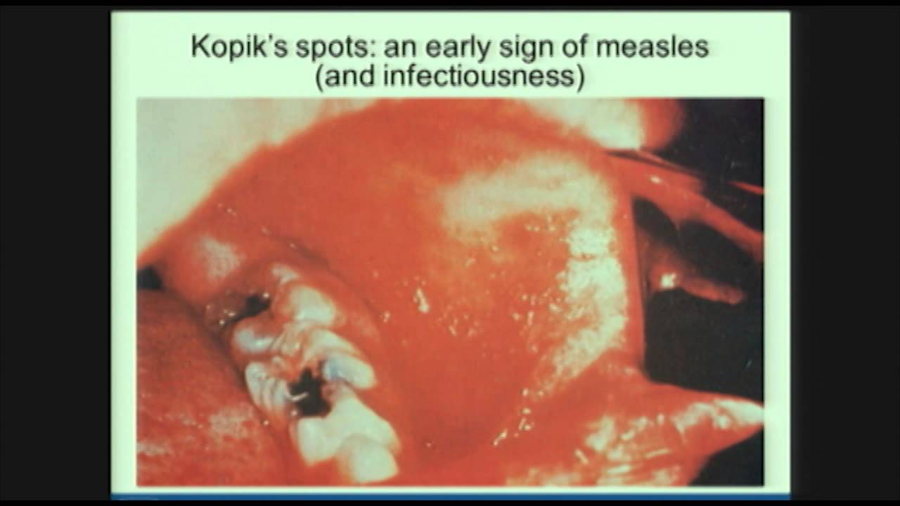What is the Measles Virus? Diane Griffin Explains at Johns Hopkins Public Health