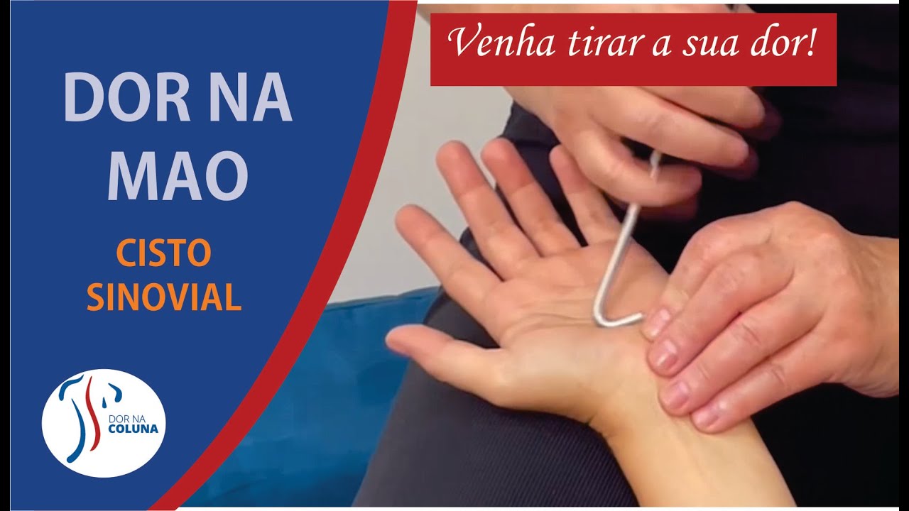 Cisto Sinovial