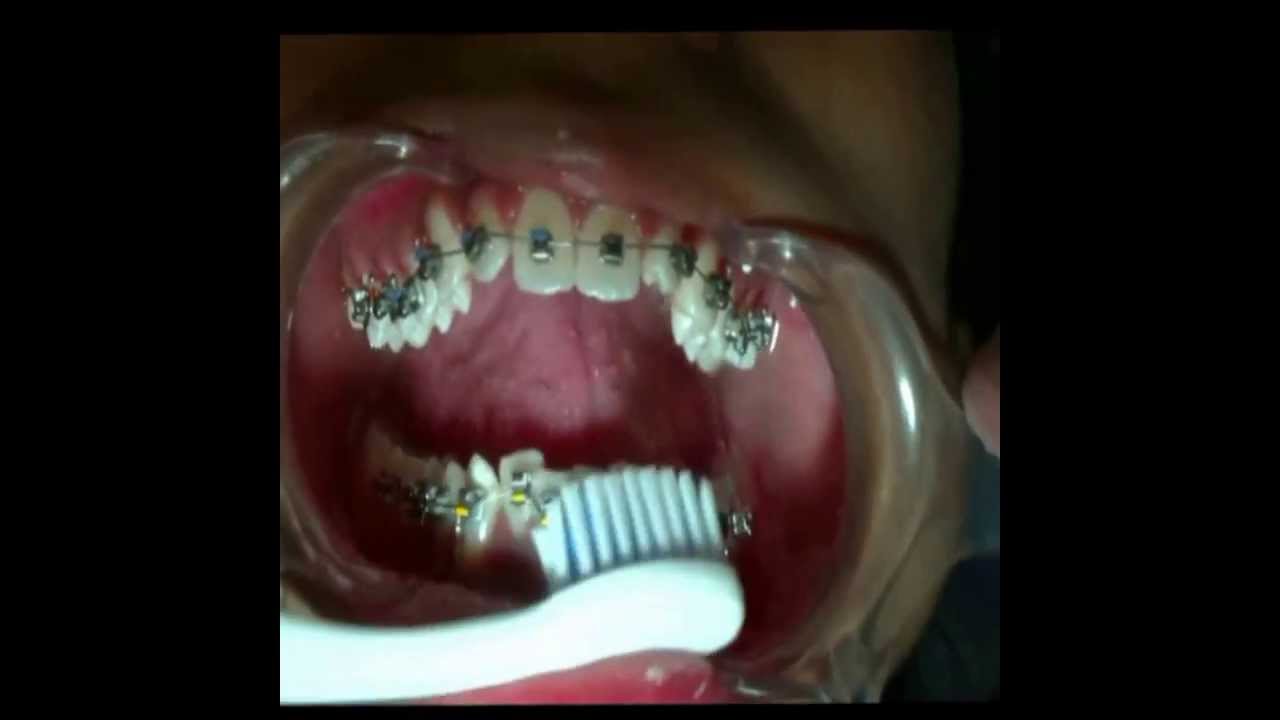Tannregulering og tannpuss. Orthodontic treatment and oral hygiene. Oral hygiene and braces.