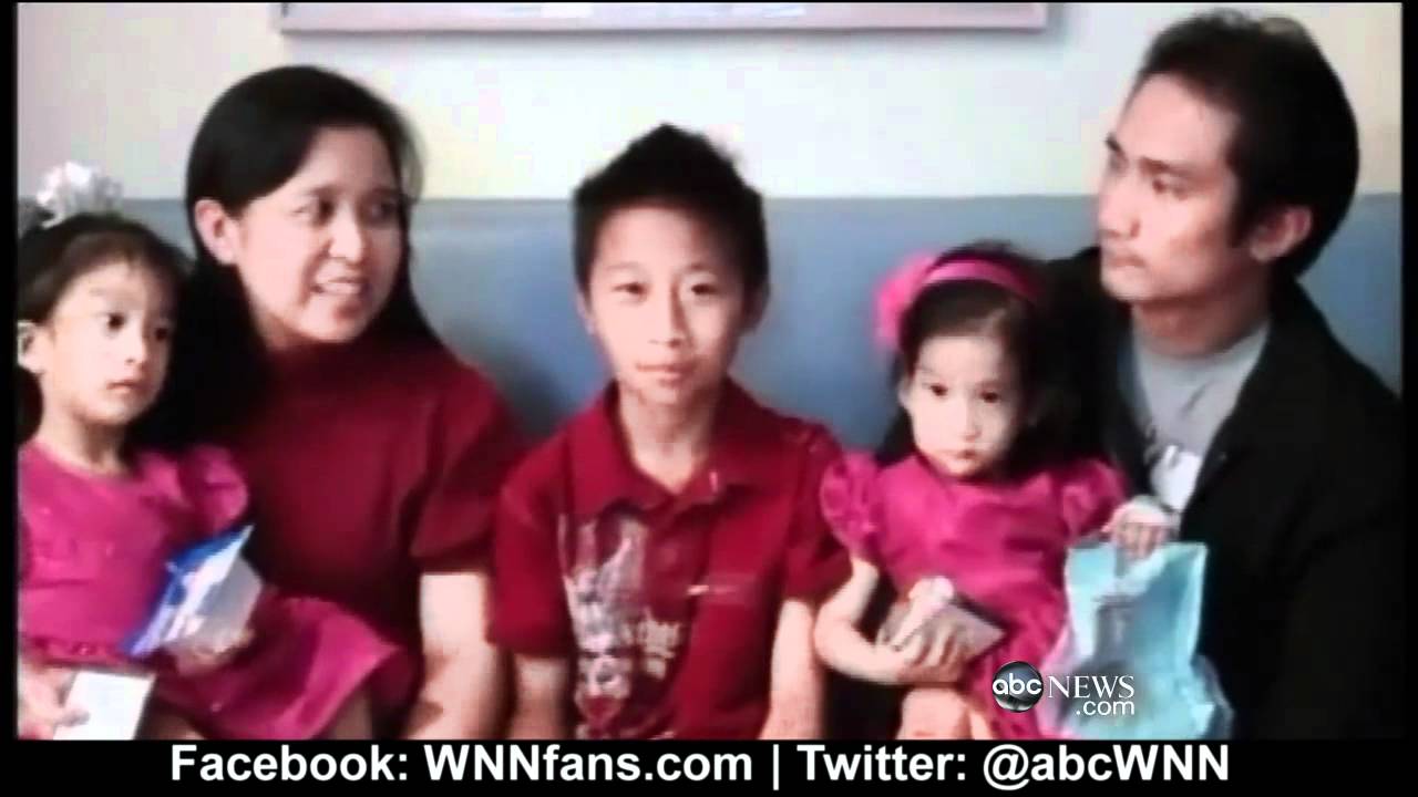 Successful Surgery Seperates Conjoined Twins