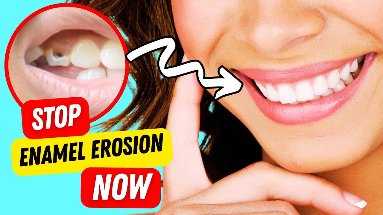 C&oacute;mo restaurar el esmalte dental NATURALMENTE en casa 🦷✨ (&iexcl;Sin necesidad de dentista!)