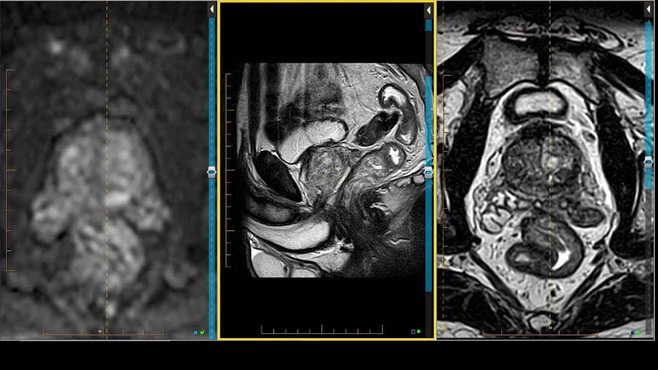 Prostate MRI - Peripheral Zone Postrial Medial (PZpm) on MRI