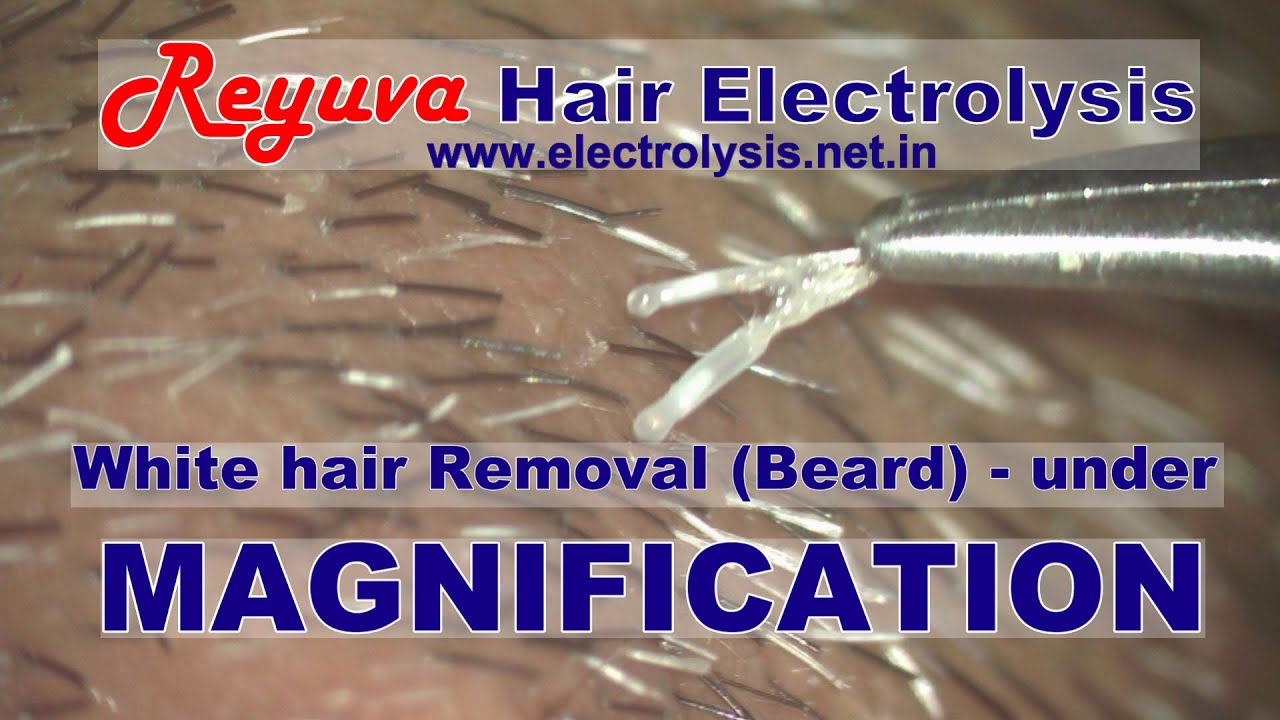 White hair removal Beard under high magnification
