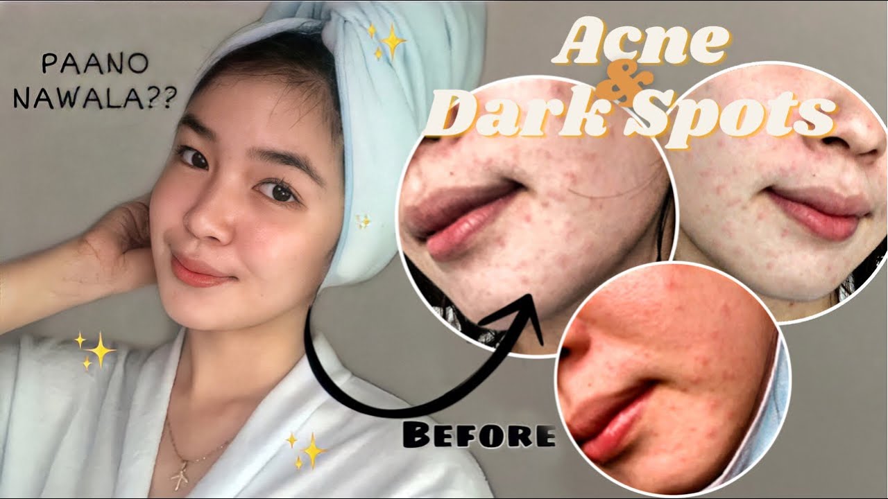 2 PRODUCTS ONLY PANGCLEAR NG ACNE AND DARK SPOTS in just 1 week?! | Updated Skincare Routine 2021