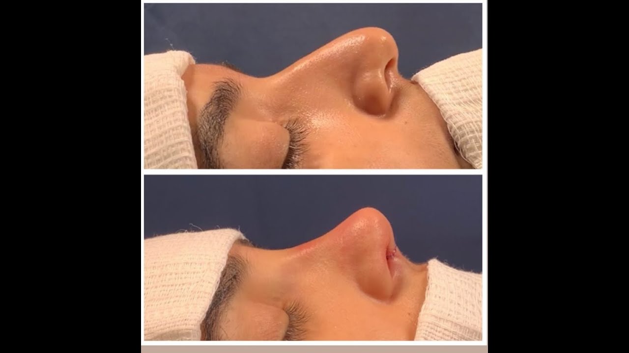 Rinoplastia pelo SUS