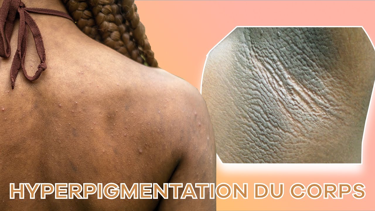 AISSELLES, COUDES, GENOUX ... FONCÉS - ROUTINE CORPS CONTRE L'HYPERPIGMENTATION !