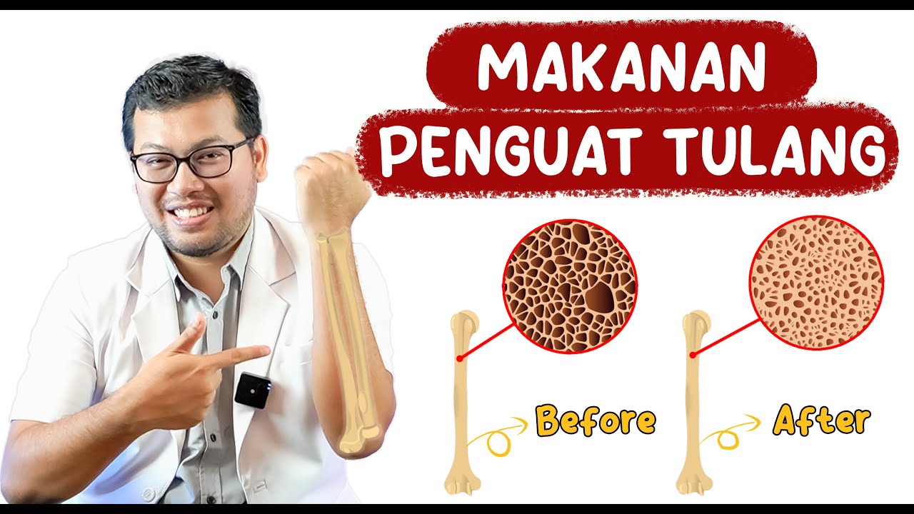 MAKANAN PENGUAT TULANG UNTUK PENDERITA OSTEOPOROSIS - DOKTER SADDAM ISMAIL