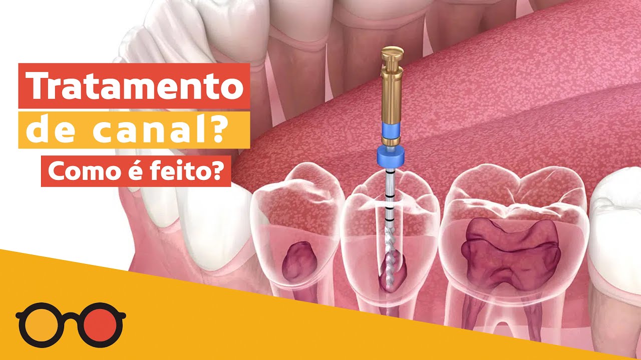 Como é feito o Tratamento de Canal? Dói?  l Plantão de Dúvidas
