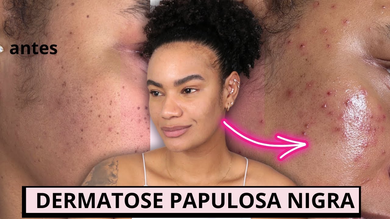 TUDO SOBRE A RETIRADA DA DERMATOSE PAPULOSA NIGRA • Patt Neves