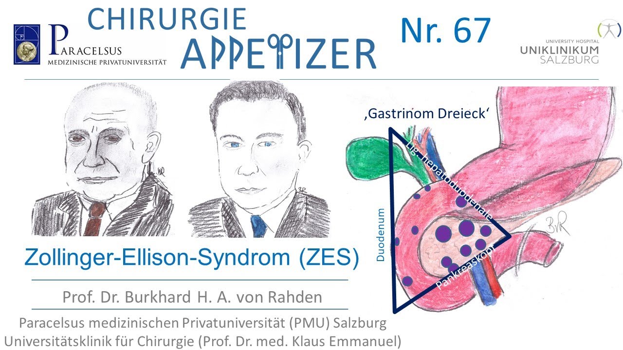 Zollinger-Ellison-Syndrom CHIRURGIE APPetizer Nr. 67