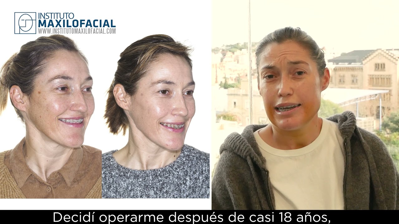 Cirugía ortofacial. Caso # 90: Teresa - Hipoplasia maxilar, mordida abierta (parte 2 de 2)